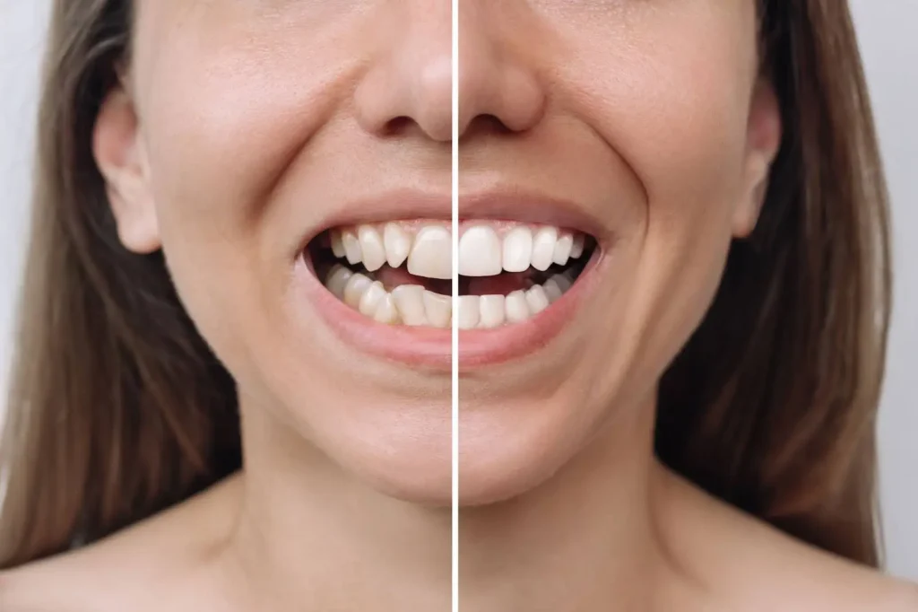 Understanding Crooked Teeth