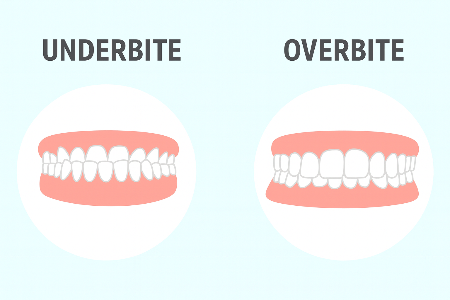 Overbite Vs Underbite