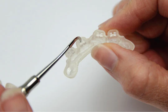 What Is Indirect Bonding Why Is It Becoming More Common Cr