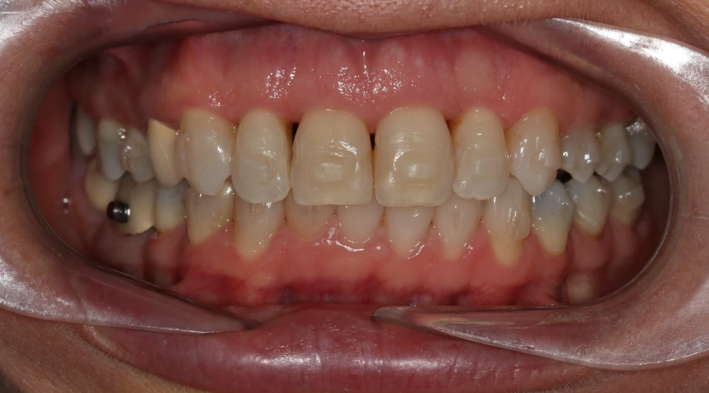 Black Triangles 1 Before