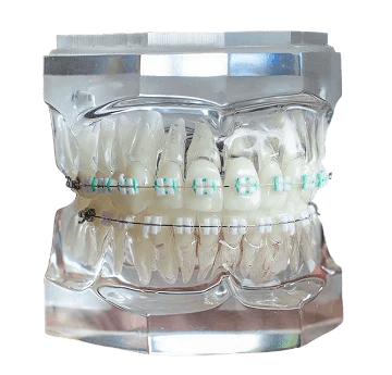 What Are Lightforce Bracee