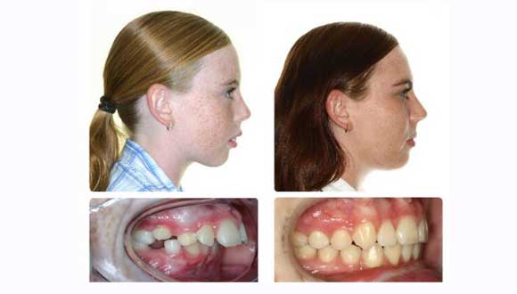 Before And After Braces Overbite Profile