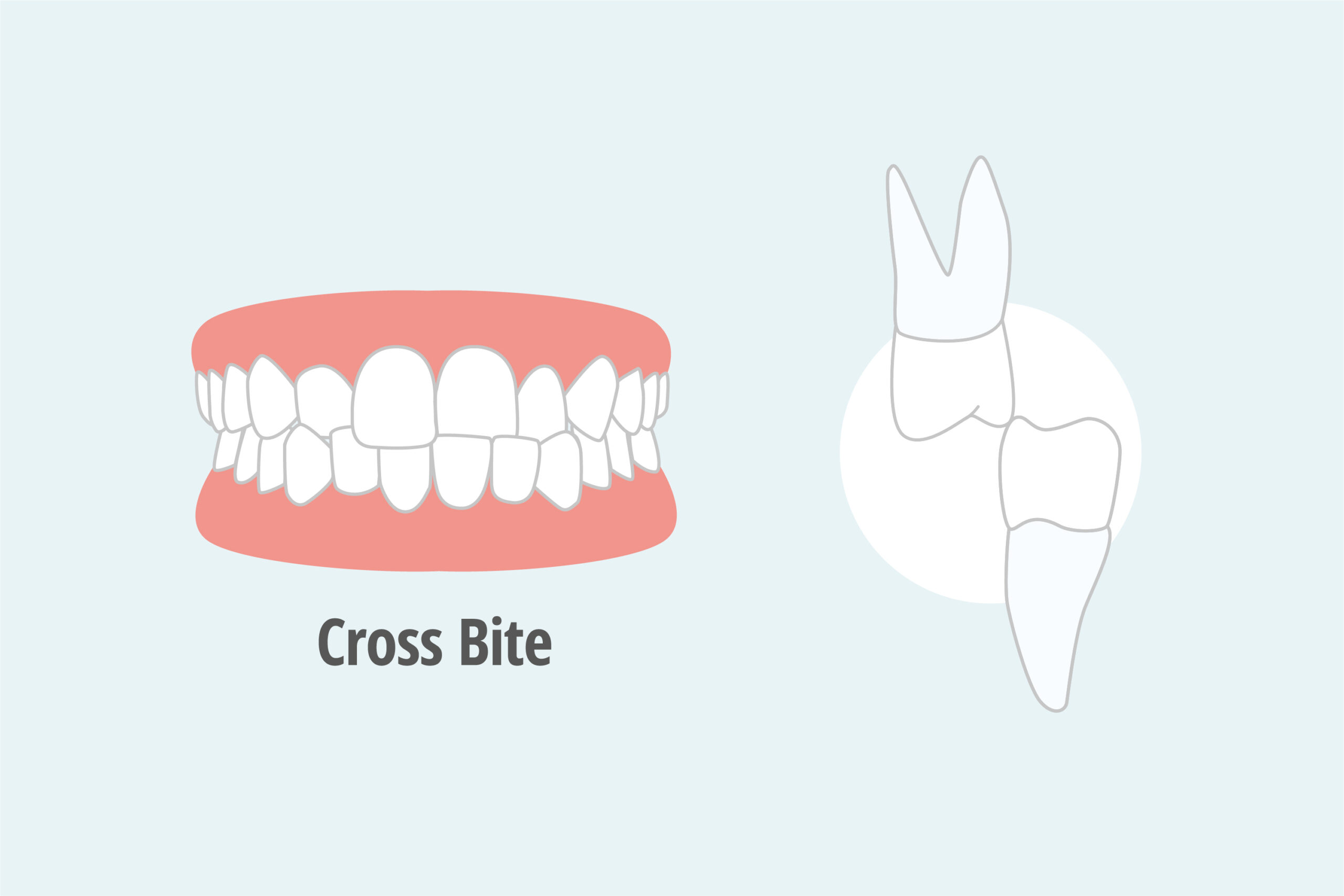 Crossbite | Common Problems | Gullotta Orthodontics