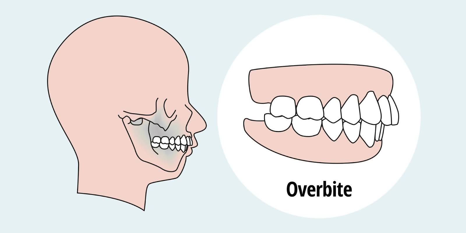 Overbite | Common Dental Problems | Gullotta Orthodontics